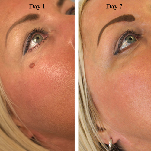 HeyTaggy™ – No More Skin Tags