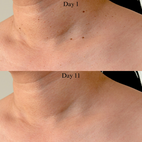 HeyTaggy™ – No More Skin Tags