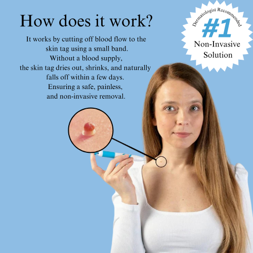 HeyTaggy™ – No More Skin Tags