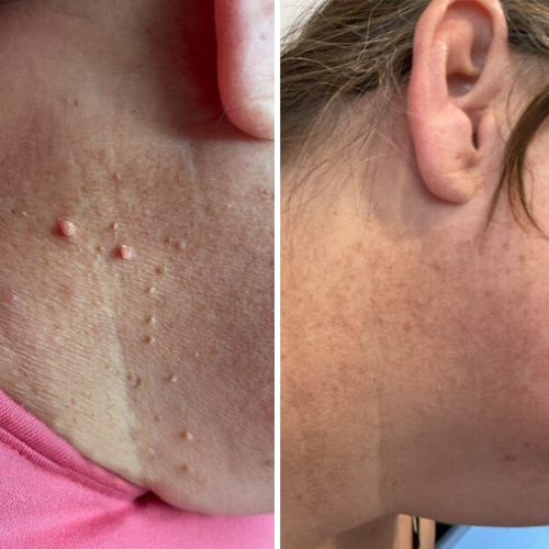 HeyTaggy™ – No More Skin Tags