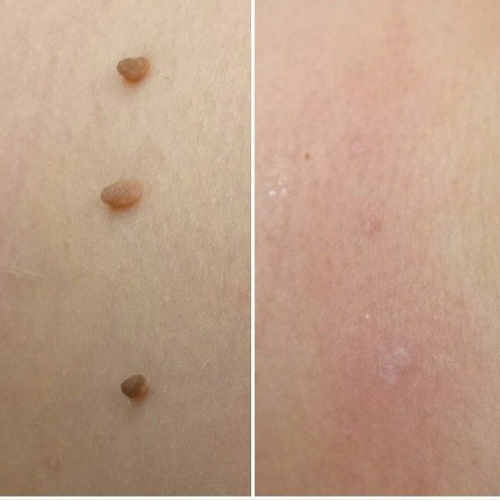 HeyTaggy™ – No More Skin Tags