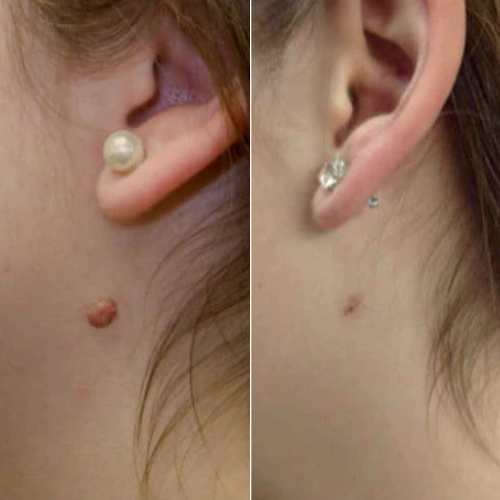 HeyTaggy™ – No More Skin Tags